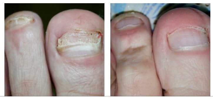 Onychomycosis  Photo